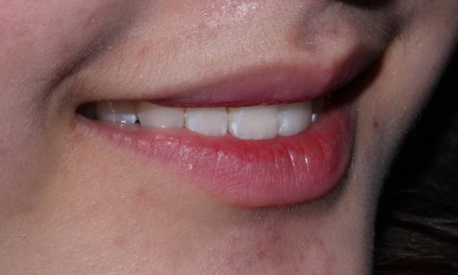 반포치과 뻐드렁니교정 방법은? 관련 이미지 9