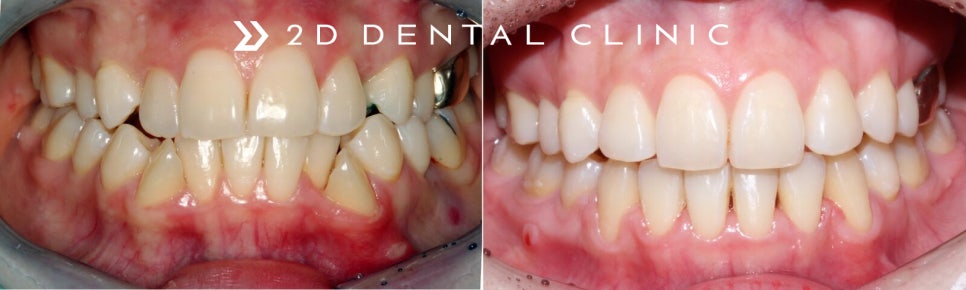 [2D치과]치아총생(Crowding)이란? 관련 이미지 2