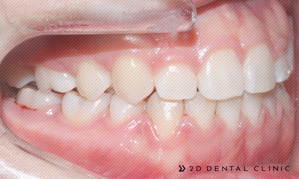 절단교합 교정 케이스 전후비교, 교정전문 2D치과 관련 이미지 17