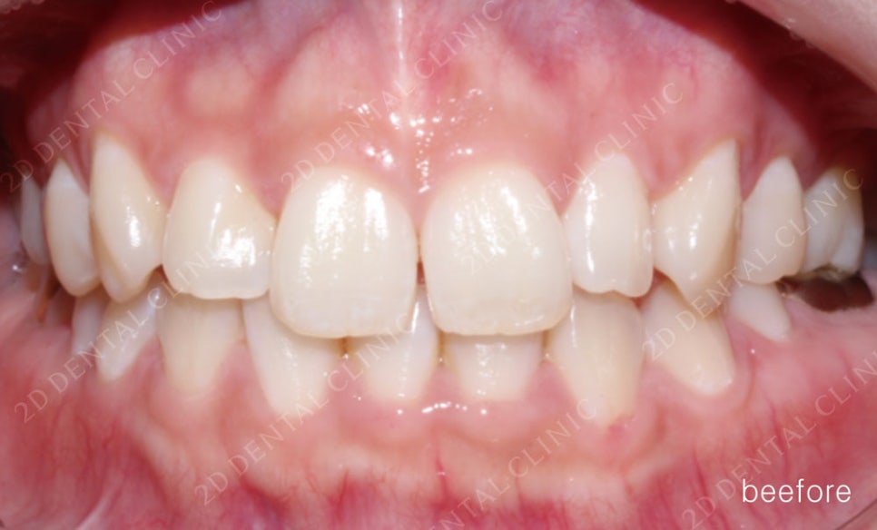 토끼이빨 치아교정 치료 사례 관련 이미지 5