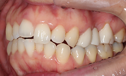 앞니틀어짐 부분교정 완성 후기 관련 이미지 5