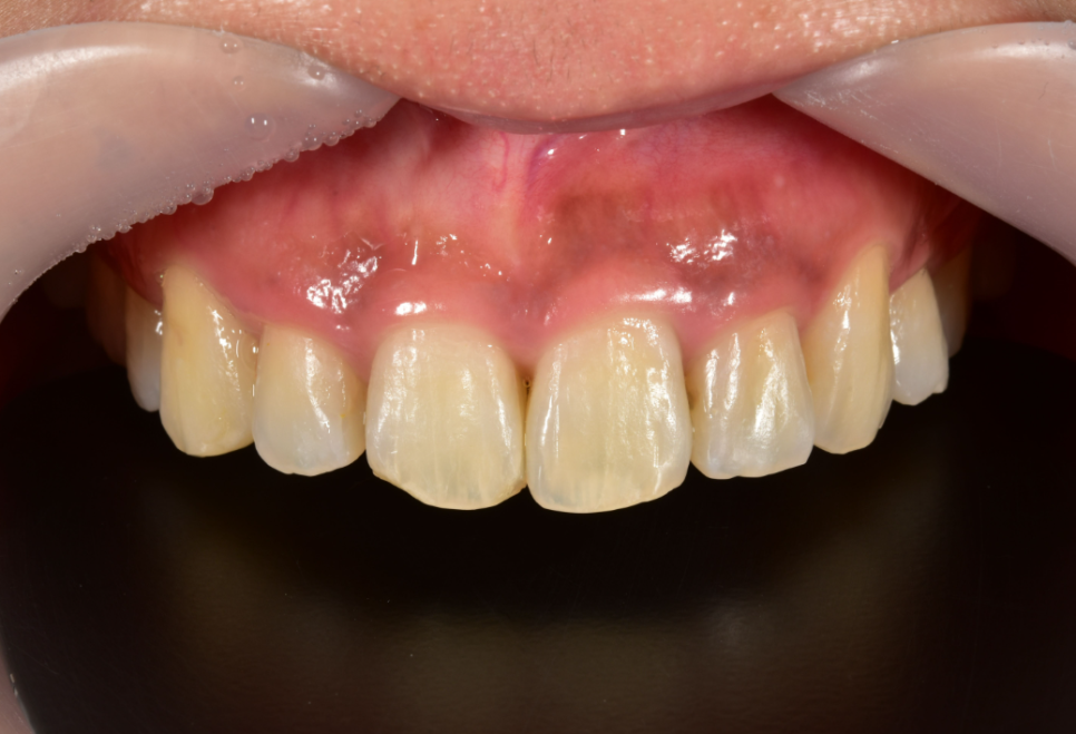 앞니깨짐 라미네이트로 자연스럽게! 관련 이미지 3