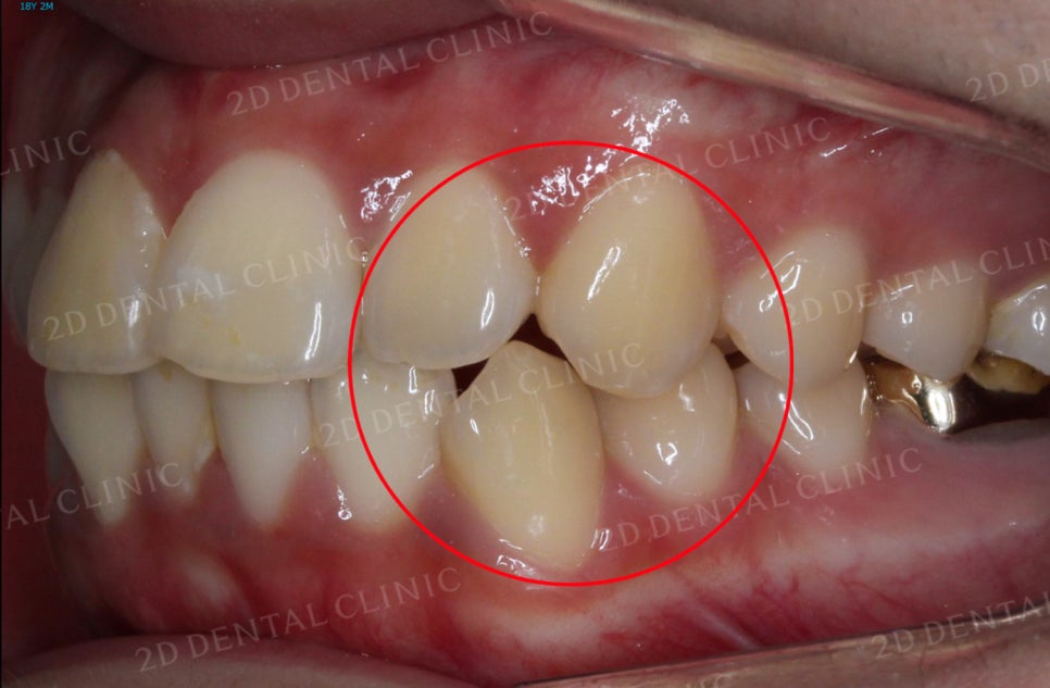 [앞니교정] 토끼앞니교정, 클리피씨 교정으로 완벽하게! by.투디치과(2D치과) 관련 이미지 14