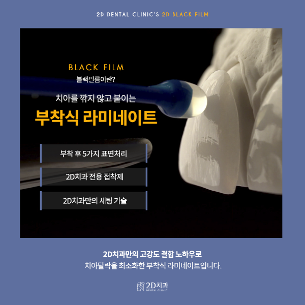 자연치 그대로 살렸다! 진짜 무삭제 라미네이트 <블랙필름> 관련 이미지 4