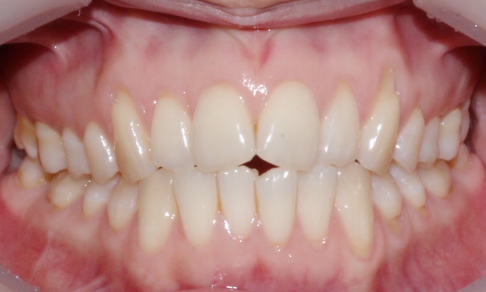 안 보이는 교정!2D교정 잘하는 강남 신논현 근처 2D치과! 관련 이미지 10