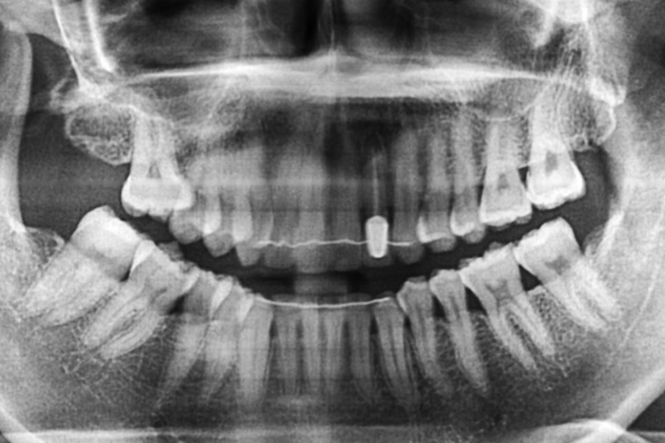 왜소치 뻐드렁니 교정 신논현역치과에서 관련 이미지 12
