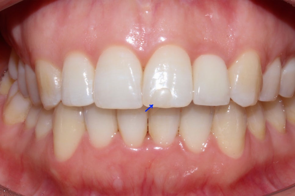 왜소치 뻐드렁니 교정 신논현역치과에서 관련 이미지 11