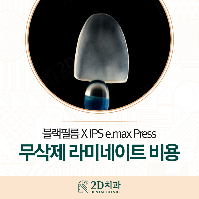 치과라미네이트 비용보다 중요한 것은? 관련 이미지 1