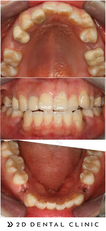 돌출입 유형 및 증상, 치과 내원 전 자가진단! 관련 이미지 12