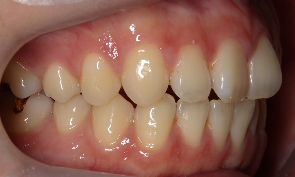 나비앞니 세라믹교정 case 관련 이미지 4