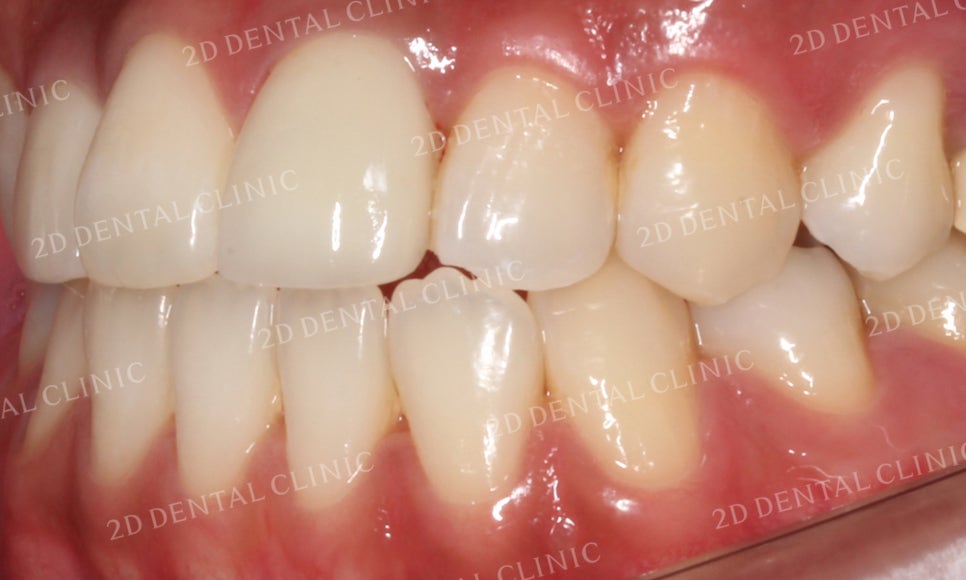 치아변색, 까맣게 변한 변색치를 블링스(Blinx)로 수복하기! by. 투디치과(2D치과) 관련 이미지 13