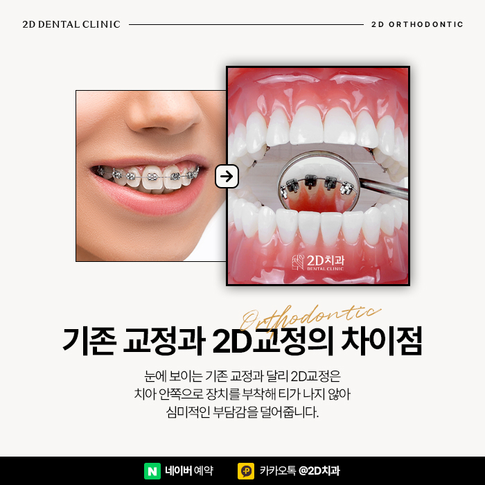 고른 앞니 치아모양을 위한 반포역 2D교정 관련 이미지 4