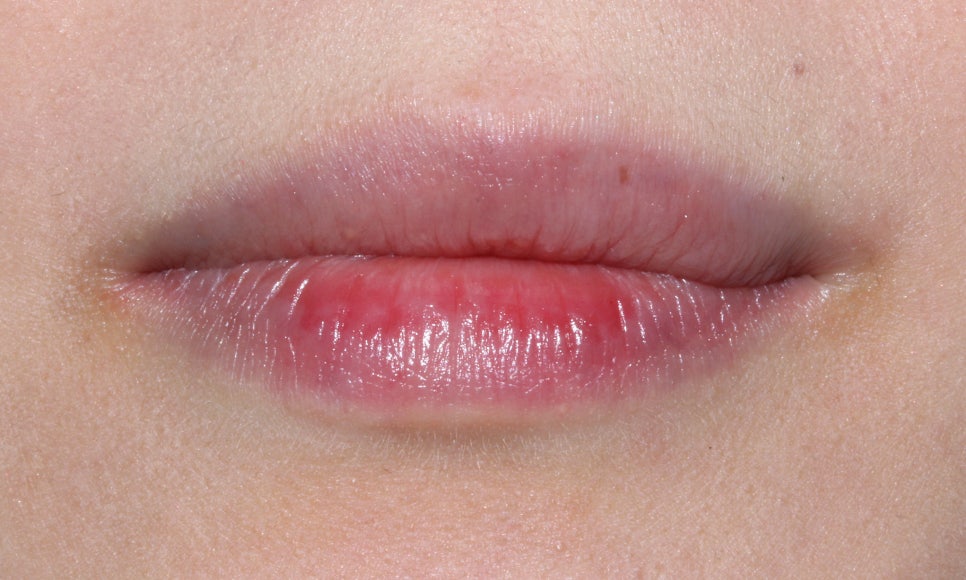 앞니틀어짐 2D교정으로 한번에 끝내는 방법! 관련 이미지 3