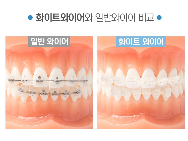 극강심미성추구[투디치과]화이트와이어(white wire) 관련 이미지 1