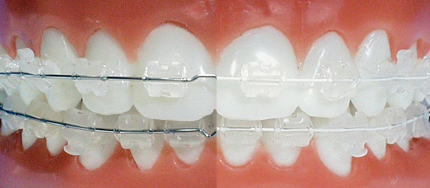 [투디(2D)치과] 치아교정에 화이트 와이어를 선택하는 이유? 관련 이미지 4