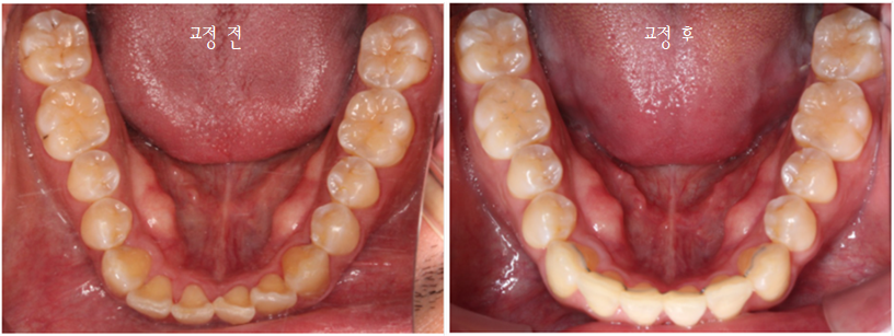 앞니 덧니 고민, 부분 설측 교정으로 해결한 사례 관련 이미지 21