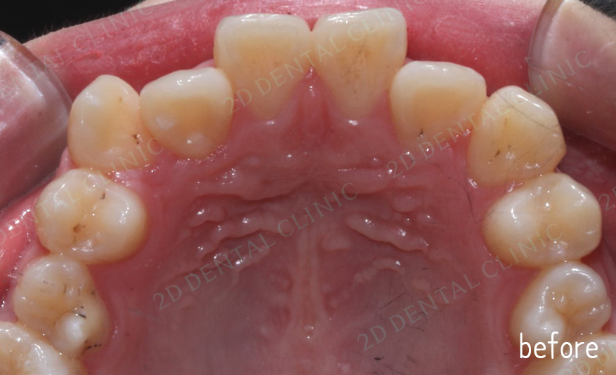 우디의 교정일기ㅣ덧니 치아교정 후기 (feat.부정교합) 관련 이미지 4