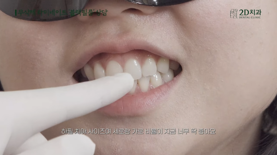 [블랙필름 상담받고 왔어요] #3 앞니가 깨졌어요 관련 이미지 14