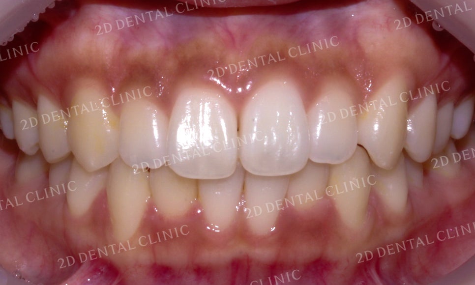 [앞니교정]토끼앞니교정, 부분교정으로 토끼이빨 탈출하기! by.투디치과(2D치과) 관련 이미지 4