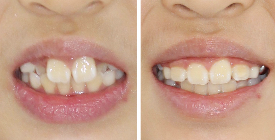 (2D)투디치과: 성장기 어린이 비발치 부정교합 후기 과정. 관련 이미지 8