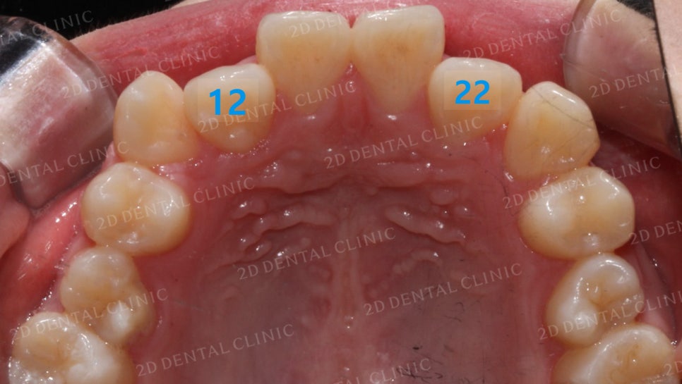 덧니치아교정, 클리피씨 전체교정으로 완벽하게! by.투디치과(2D치과) 관련 이미지 16