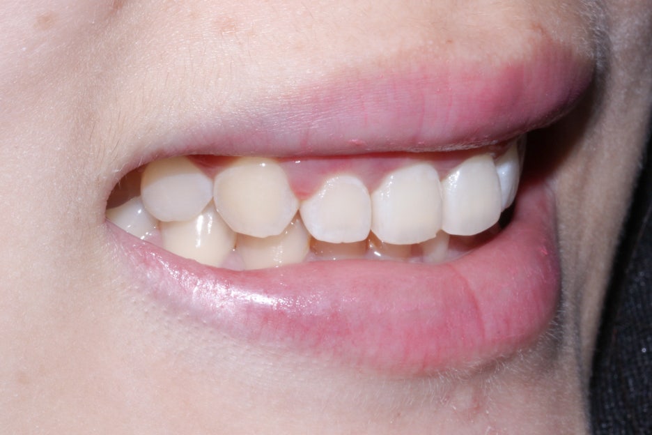 옥니교정 방법! 세라믹교정 Case 관련 이미지 10