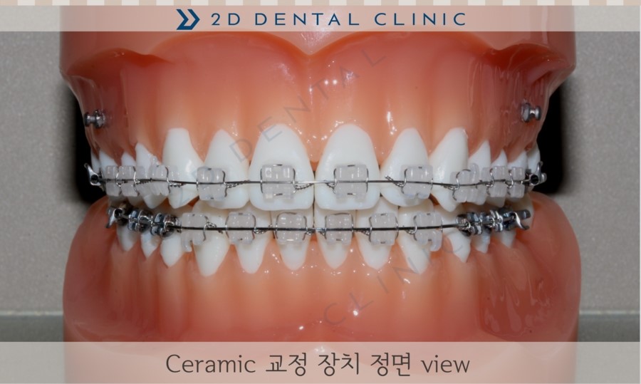 [교정상식] 전체교정 장치 종류 및 장단점! 관련 이미지 1