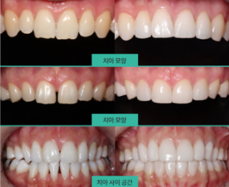 라미네이트잘하는곳 무삭제라미 블랙필름 2D치과 관련 이미지 3