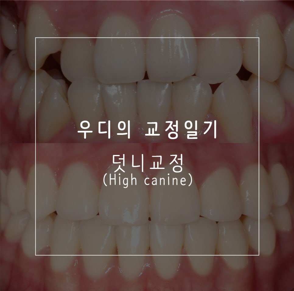 우디의 교정일기ㅣ덧니 치아교정 후기 (feat.부정교합) 관련 이미지 1