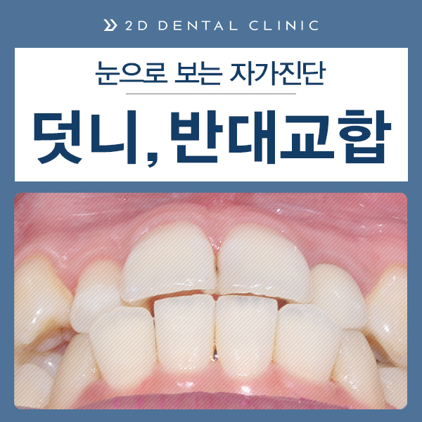 케이스로 확인하는 덧니 부정교합, 교정전문 2D치과 관련 이미지 2