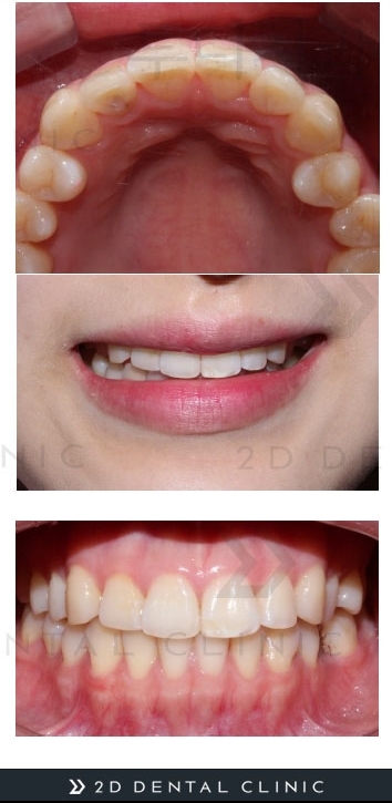 토끼이빨, 앞니 부분교정으로 단기간에! 강남 투디치과 관련 이미지 5