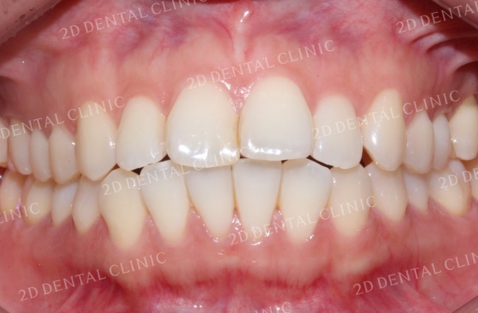 비대칭 앞니, 돌출앞니를 전체 교정으로 교정하고 싶다면!? by.투디치과(2D치과) 관련 이미지 3