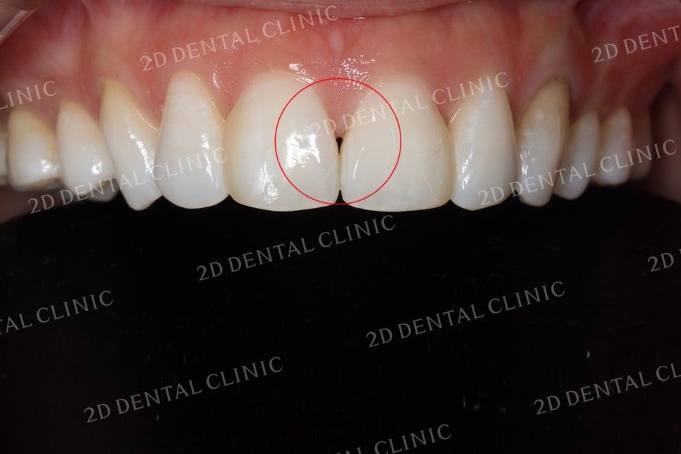 치아틈새를 완벽하게 메꾸자! 블랙트라이앵글 쎄라필름으로 완전 삭제! by.투디치과(2D치과) 관련 이미지 11