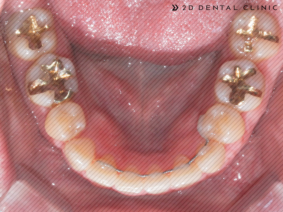 발치교정 돌출입 케이스, 교정전문 2D치과 관련 이미지 12