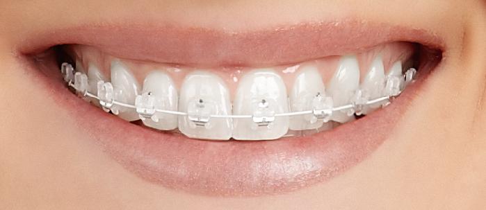 클리피씨 교정 가격 얼마일까? 강남 2D치과 관련 이미지 1