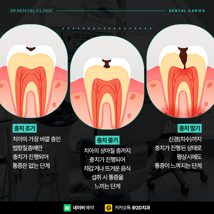 충치치료비용 아끼는 방법, 신논현 충치치료 잘하는 곳 관련 이미지 4