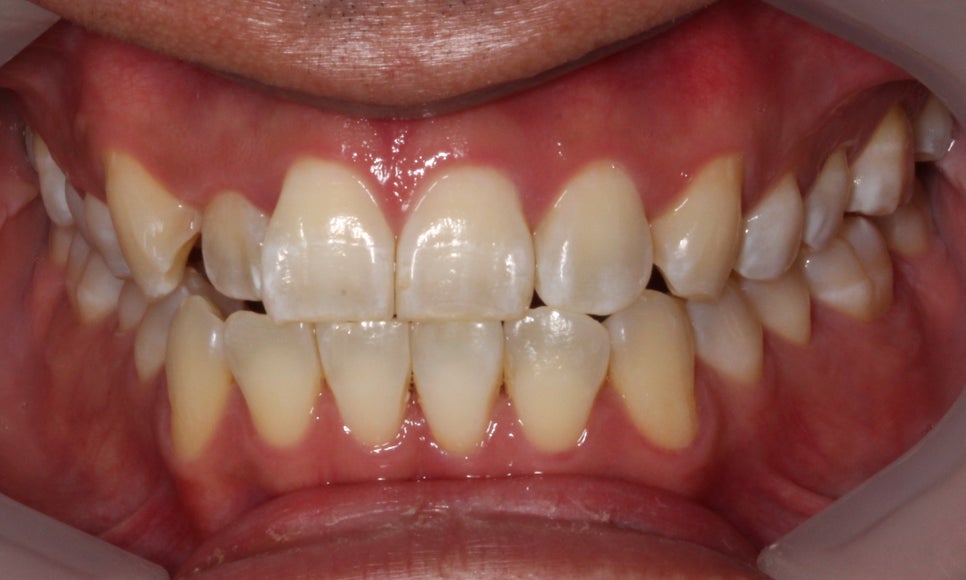 앞니 덧니 고민, 부분 설측 교정으로 해결한 사례 관련 이미지 5