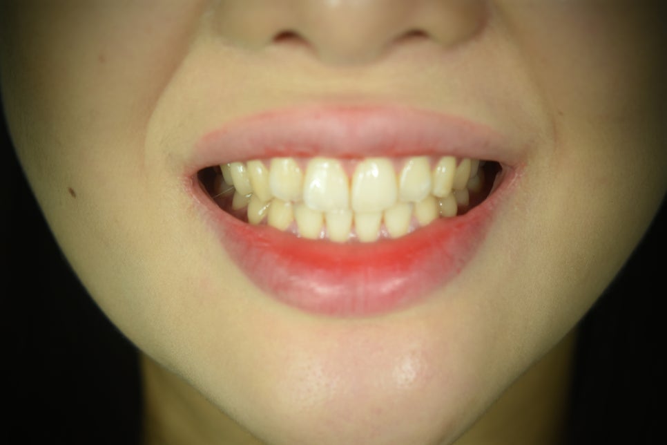 라미네이트치과 알아본다면? 관련 이미지 2