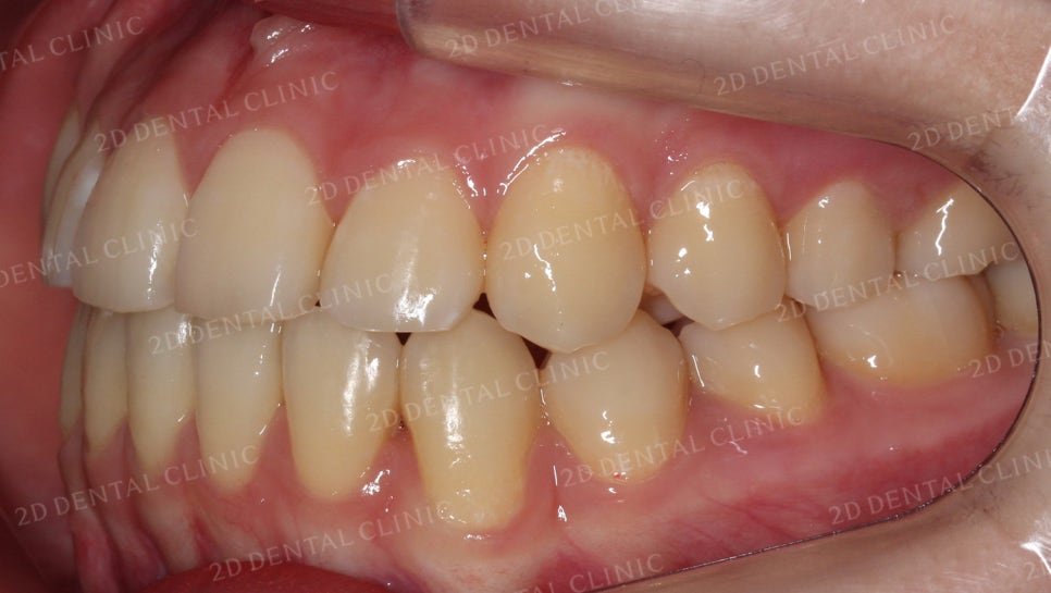 덧니치아교정, 클리피씨 전체교정으로 완벽하게! by.투디치과(2D치과) 관련 이미지 15