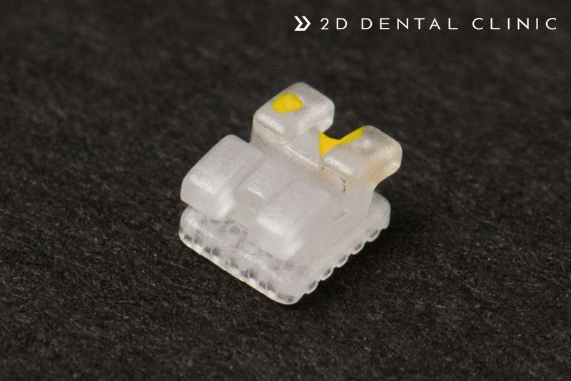 앞니 부분교정 전체교정 비교, 강남 2D치과 관련 이미지 4