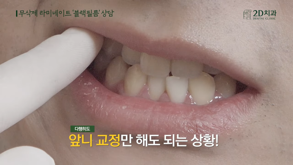 [블랙필름 상담받고 왔어요] #2 반대교합도 가능할까요? 관련 이미지 12