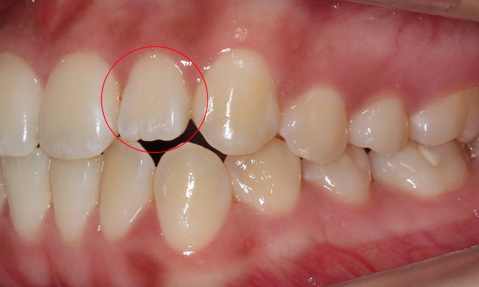 톱니모양 치아를 매끄러운 치아모양으로 개선하는 방법! (마멜론치아) 관련 이미지 3
