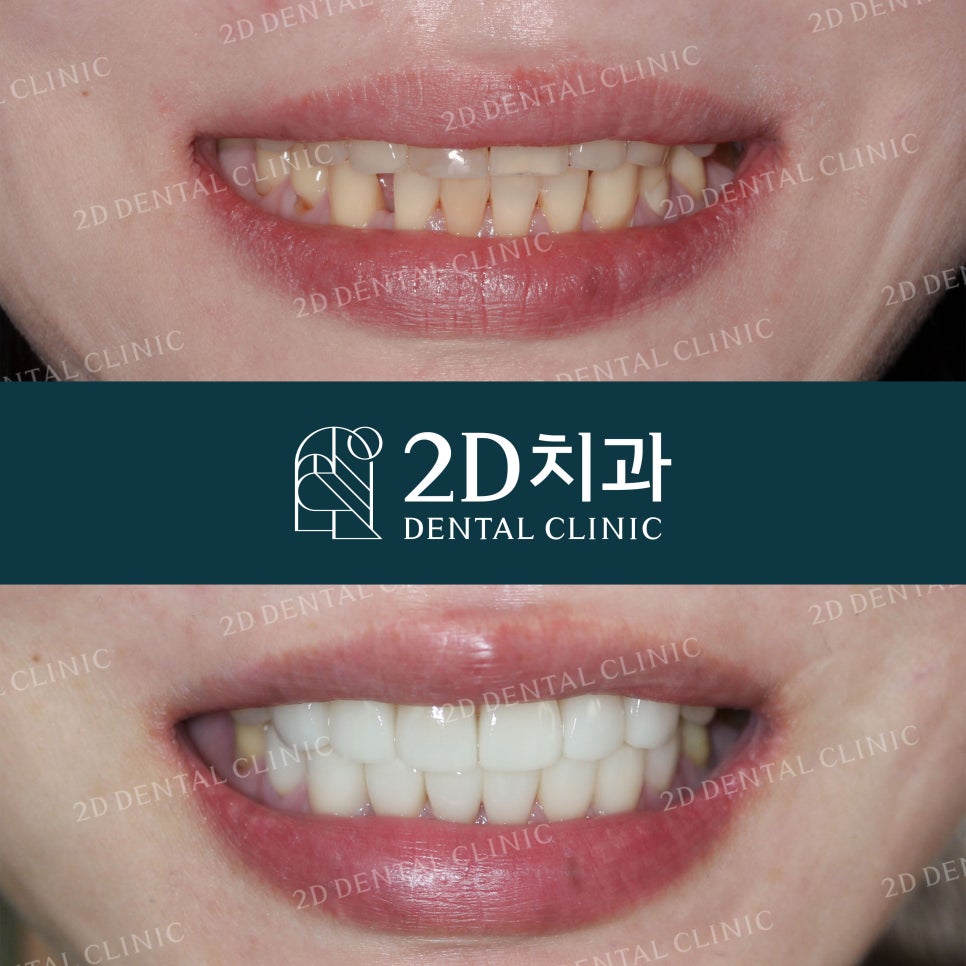 누렇고 손상된 치아를 밝고 가지런하게! by. 투디치과(2D치과)_블링스 시술후기 관련 이미지 1