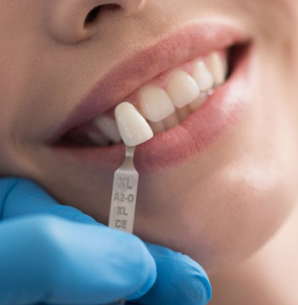 강남라미네이트 무삭제 치아성형 블랙필름 관련 이미지 6