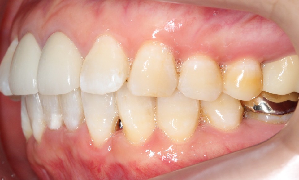 2D치과 2D부분교정으로 아랫니만 빠르게! 관련 이미지 7