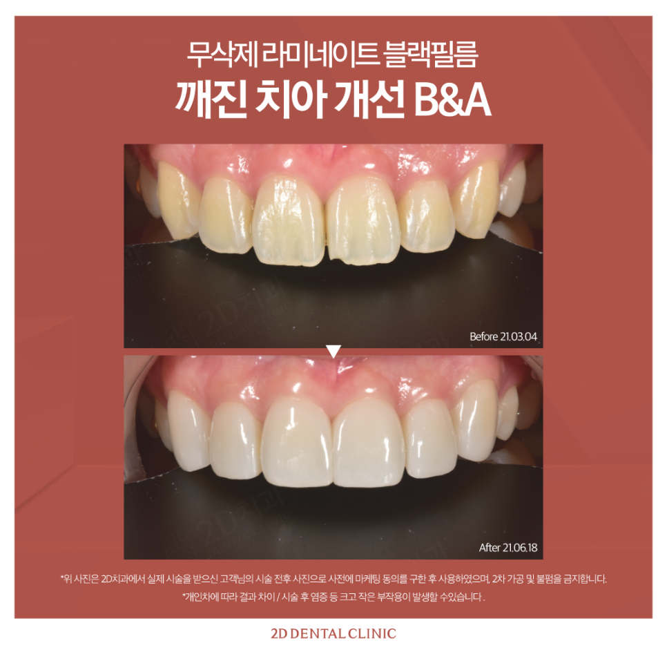 창원무삭제라미네이트 치아균열 이에 생긴 금, 어떻게 해야 할까? 관련 이미지 6