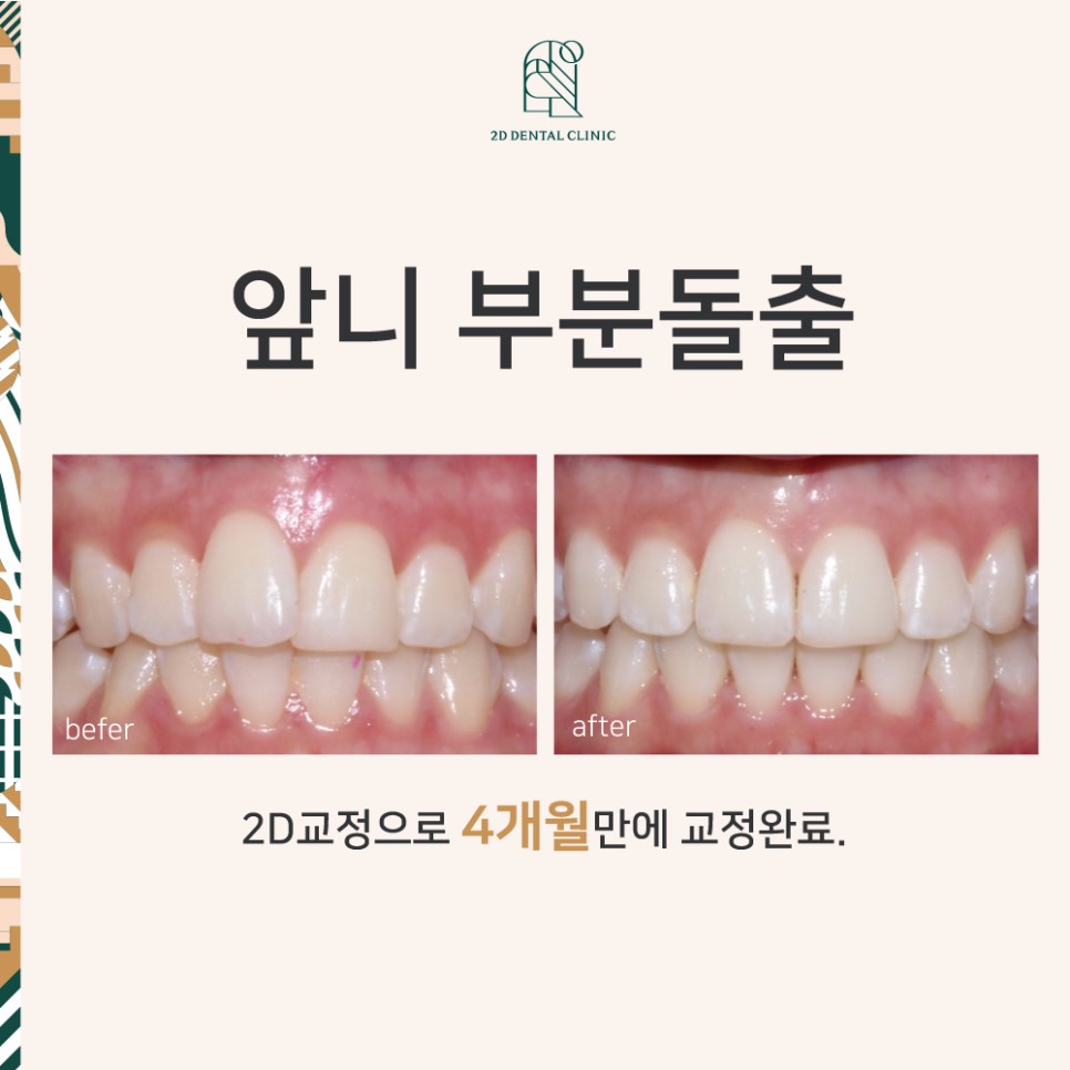 [신논현역치과] 앞니돌출 2D교정으로 개선! 관련 이미지 1