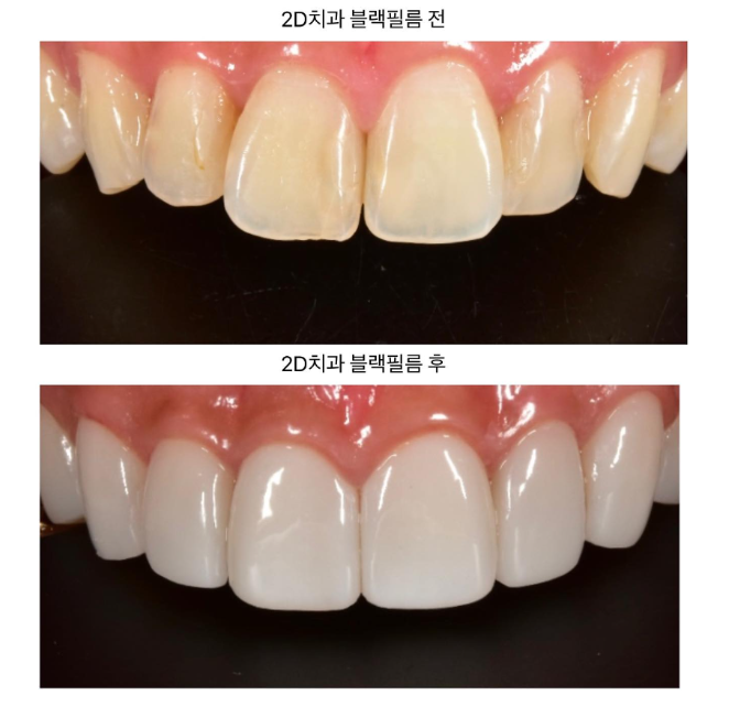 토끼 앞니라미네이트 치아삭제 없이 무삭제라미네이트 블랙필름으로 개선 관련 이미지 5