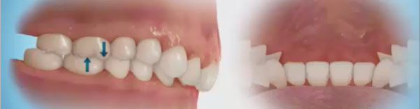 과개교합 케이스도 2D치과에서 해결! 관련 이미지 1