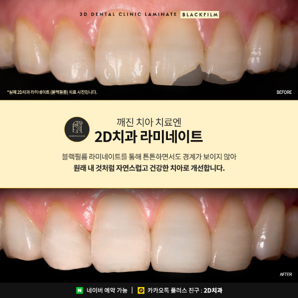 "깨진 앞니 방치하면 안 돼요!" 2D치과 맞춤 치료법 관련 이미지 4